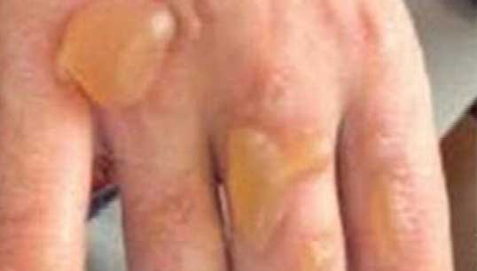 hand_sanitiser_burns_warning_web.jpg