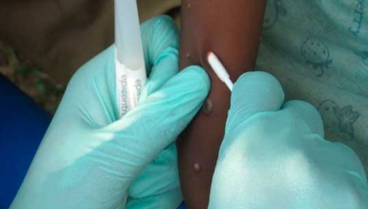Image:Monkeypox sampling. Image: Wikimedia Commons